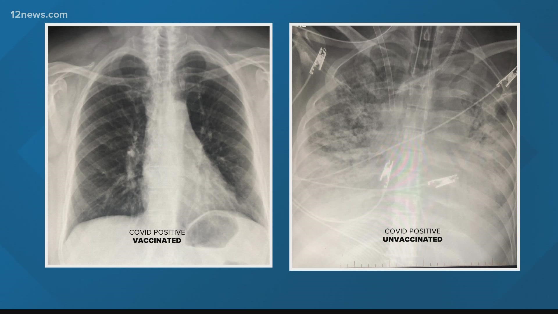 COVID19 Xrays show vaccine efficacy on lungs