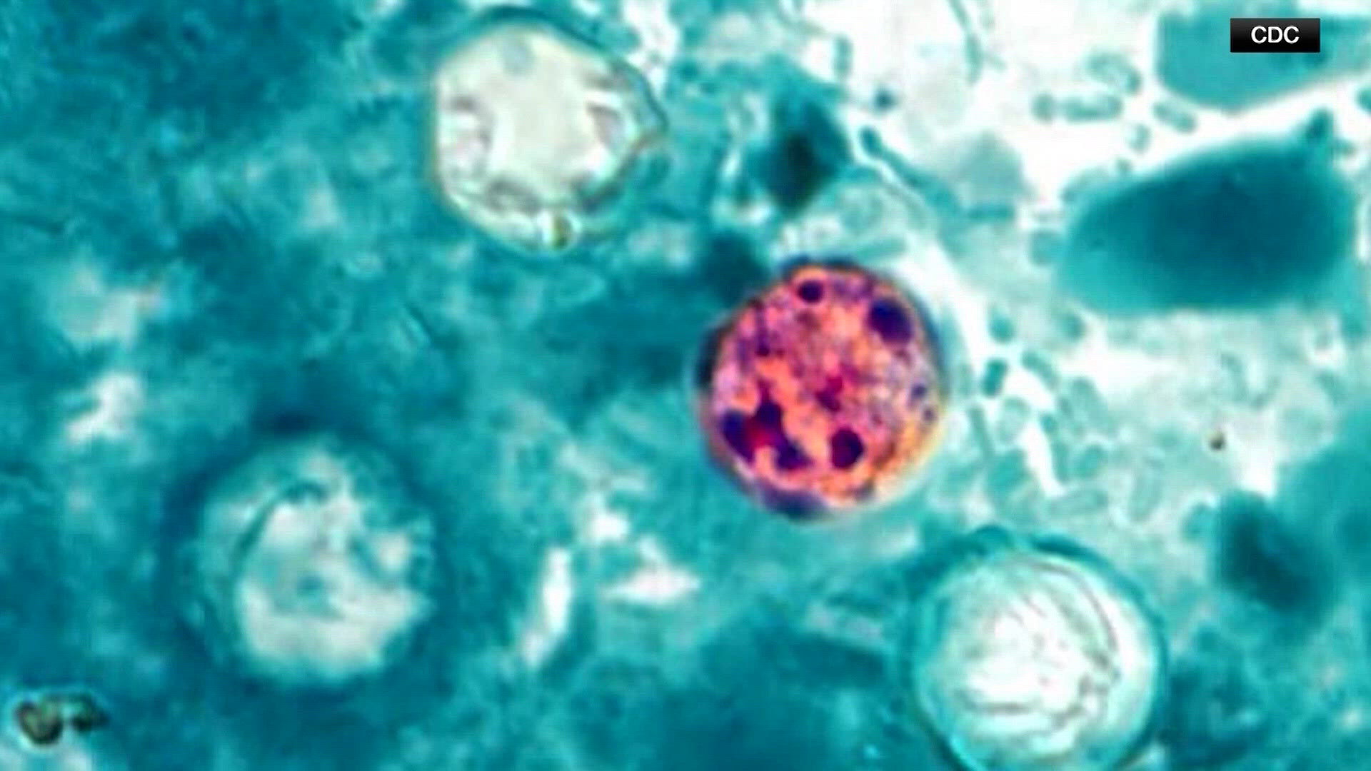 New Cyclospora numbers released for Texas, including North Texas counties