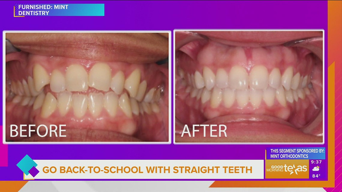 Go Back to School with straight teeth