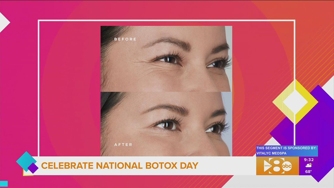 Celebrating National Botox Day