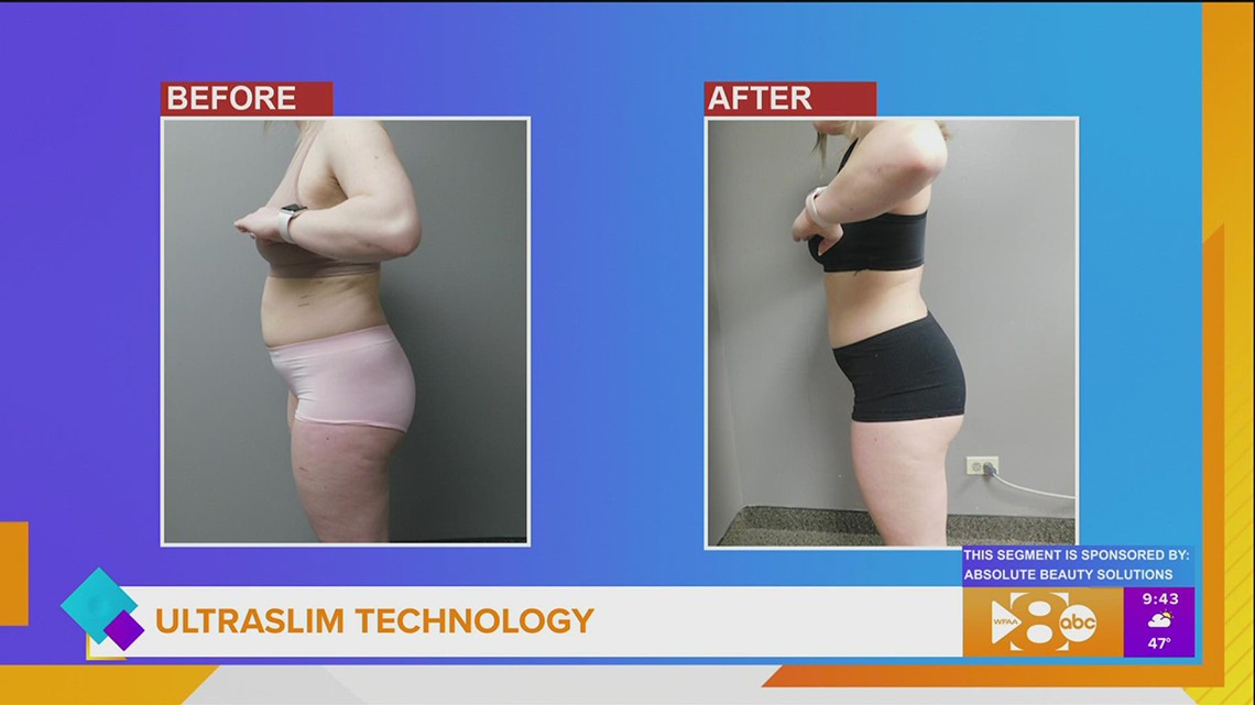 How Ultraslim Works with Absolute Beauty Solutions
