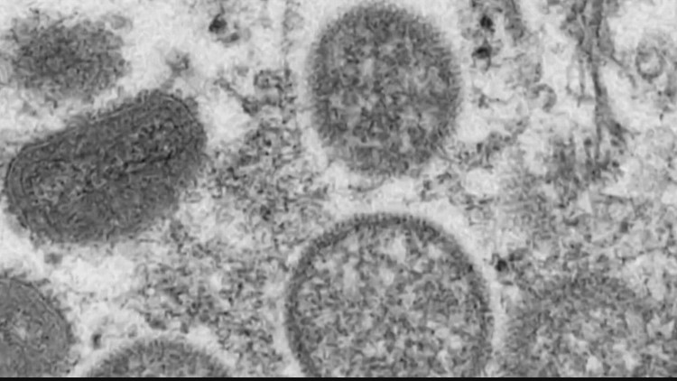 Two monkeypox vaccine clinics planned in Dallas