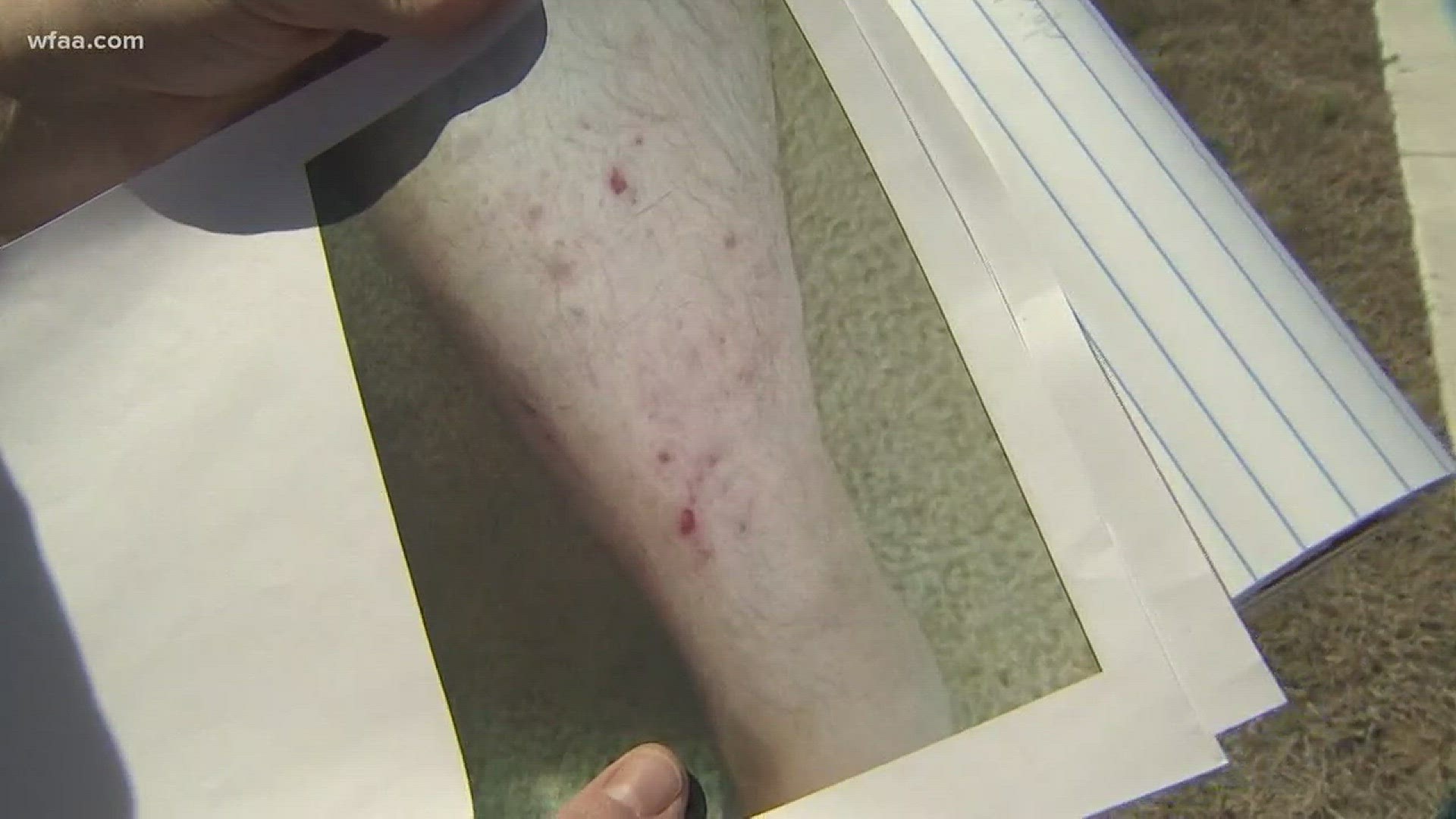 Ponder residents claim water is causing rashes