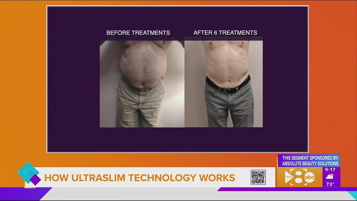 Sponsored How UltraSlim Technology Works at Absolute Beauty Solutions