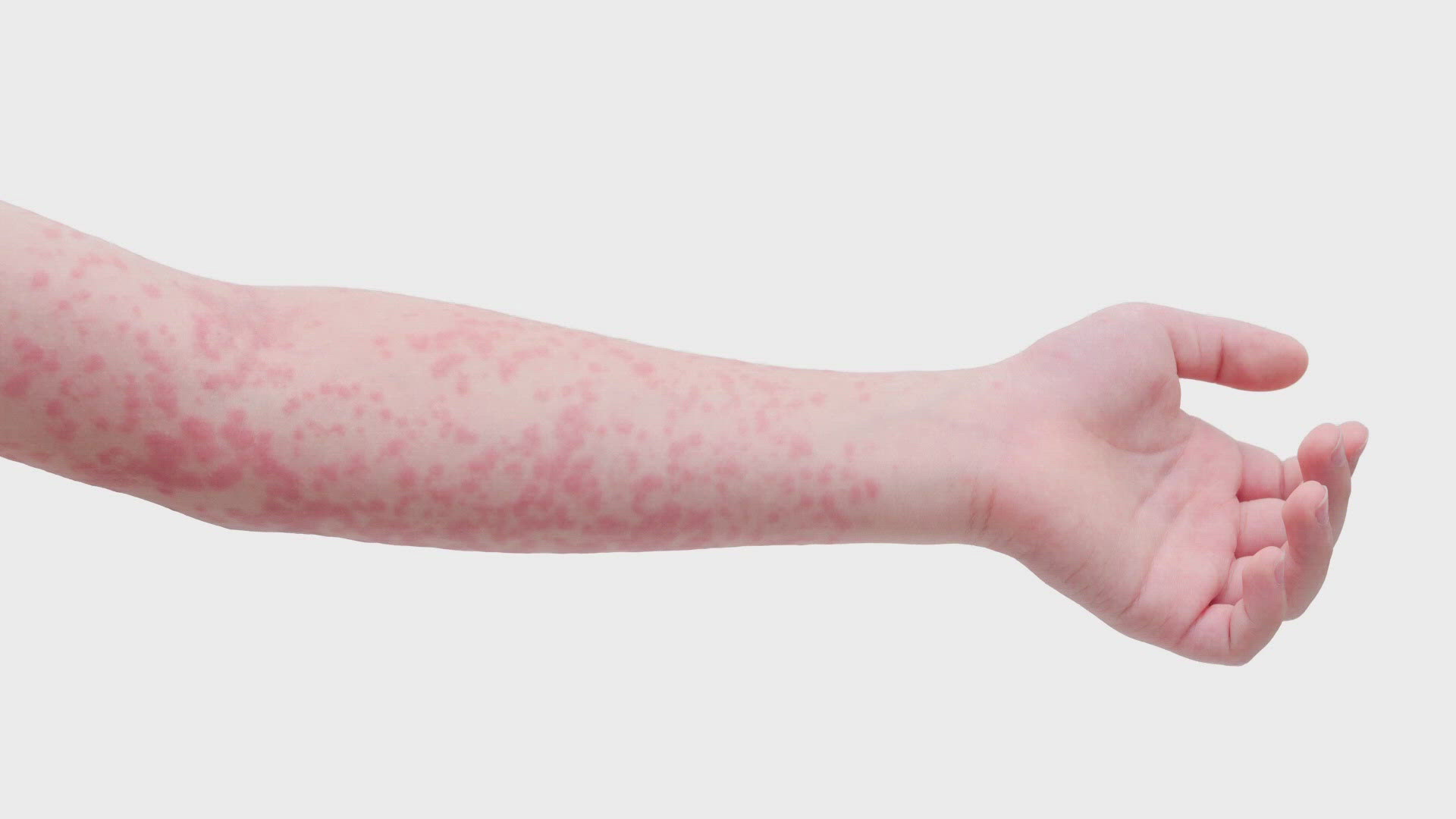 A student who attends Willow Springs Middle School in Lucas tested positive for measles, Collin County Health Services confirmed. 