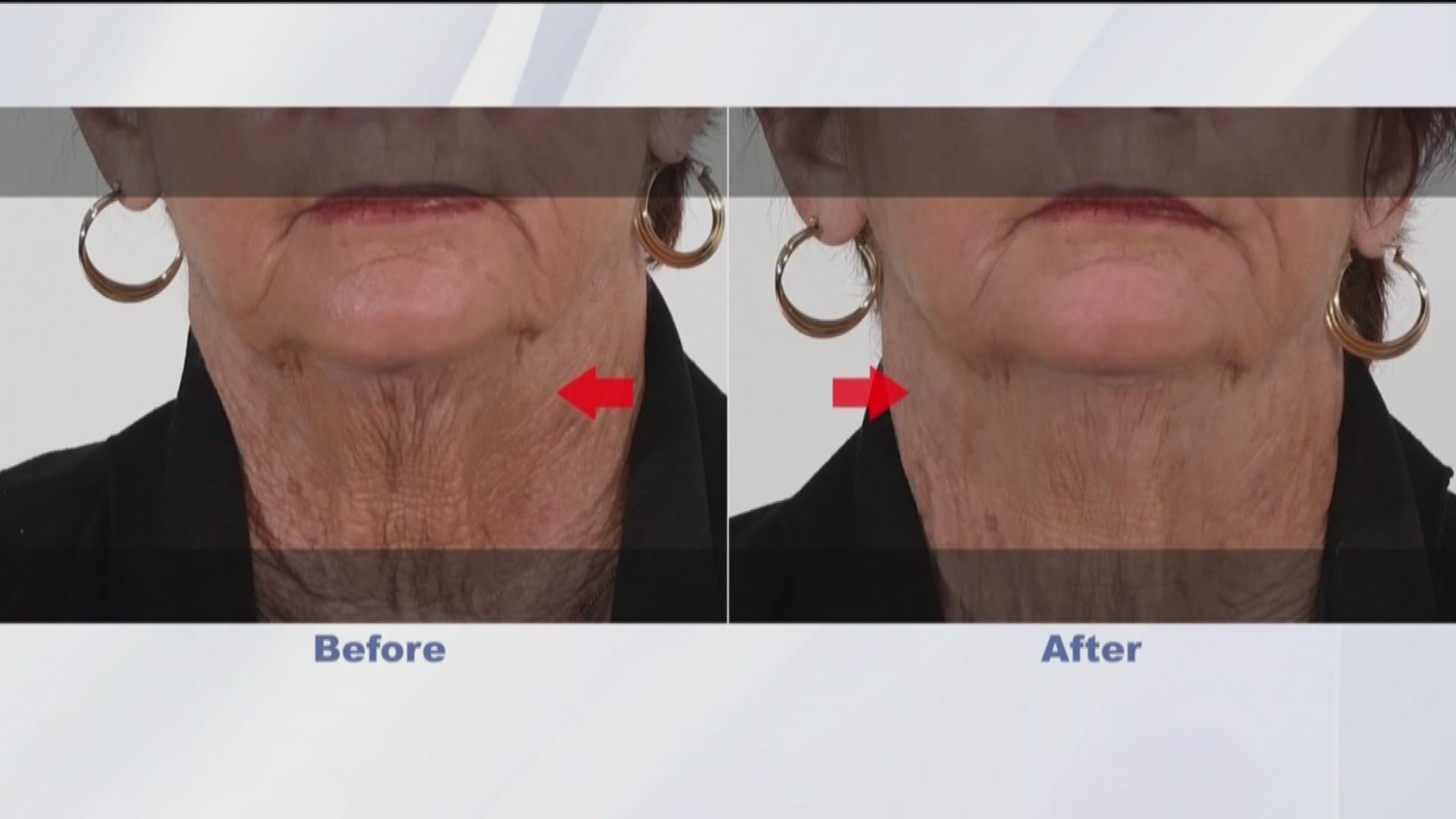 Plexaderm Erases Signs of Aging. Go to plexaderm.com for more information. 