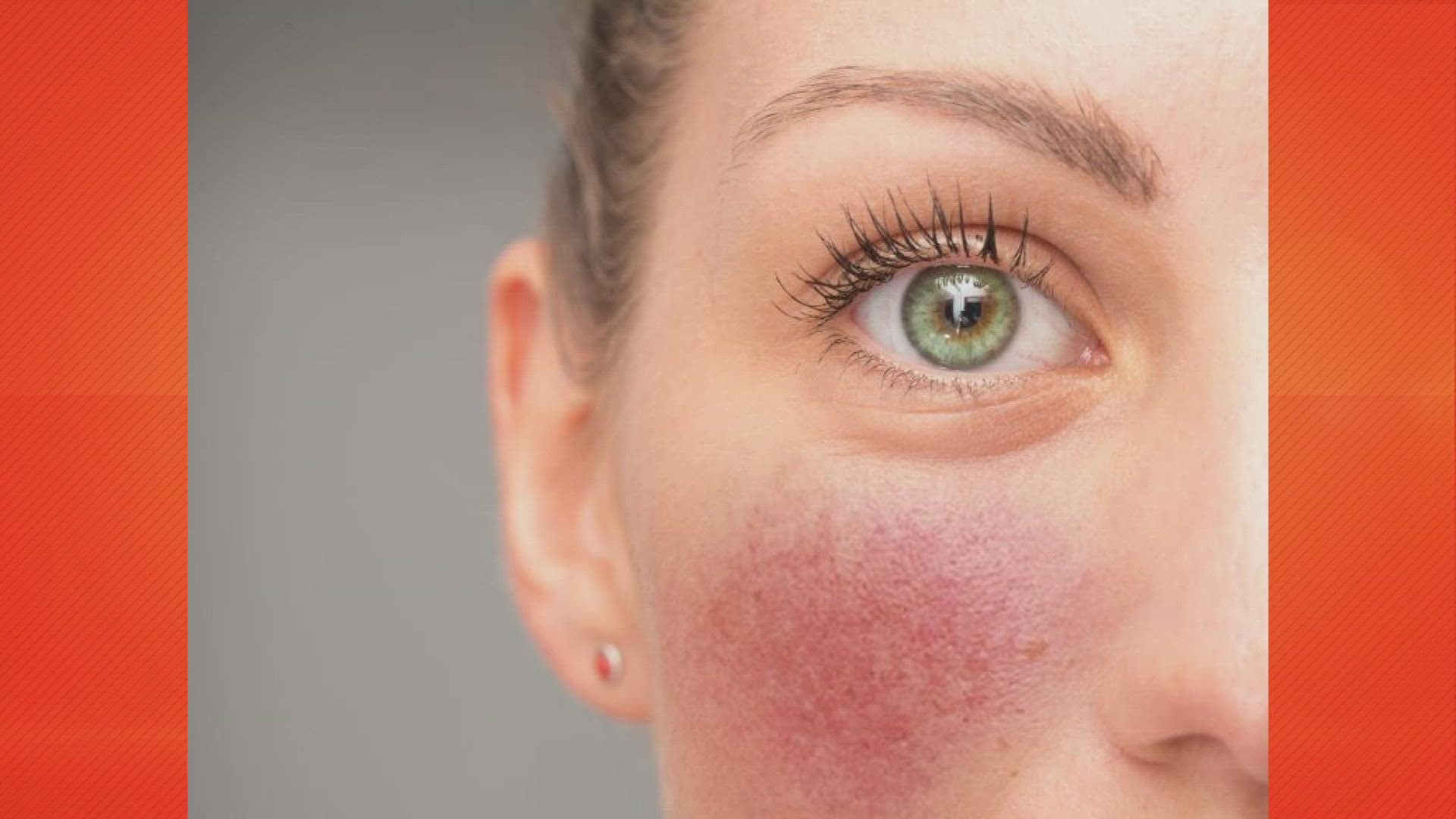 One expert shares the best treatment tips for the millions struggling with rosacea.
