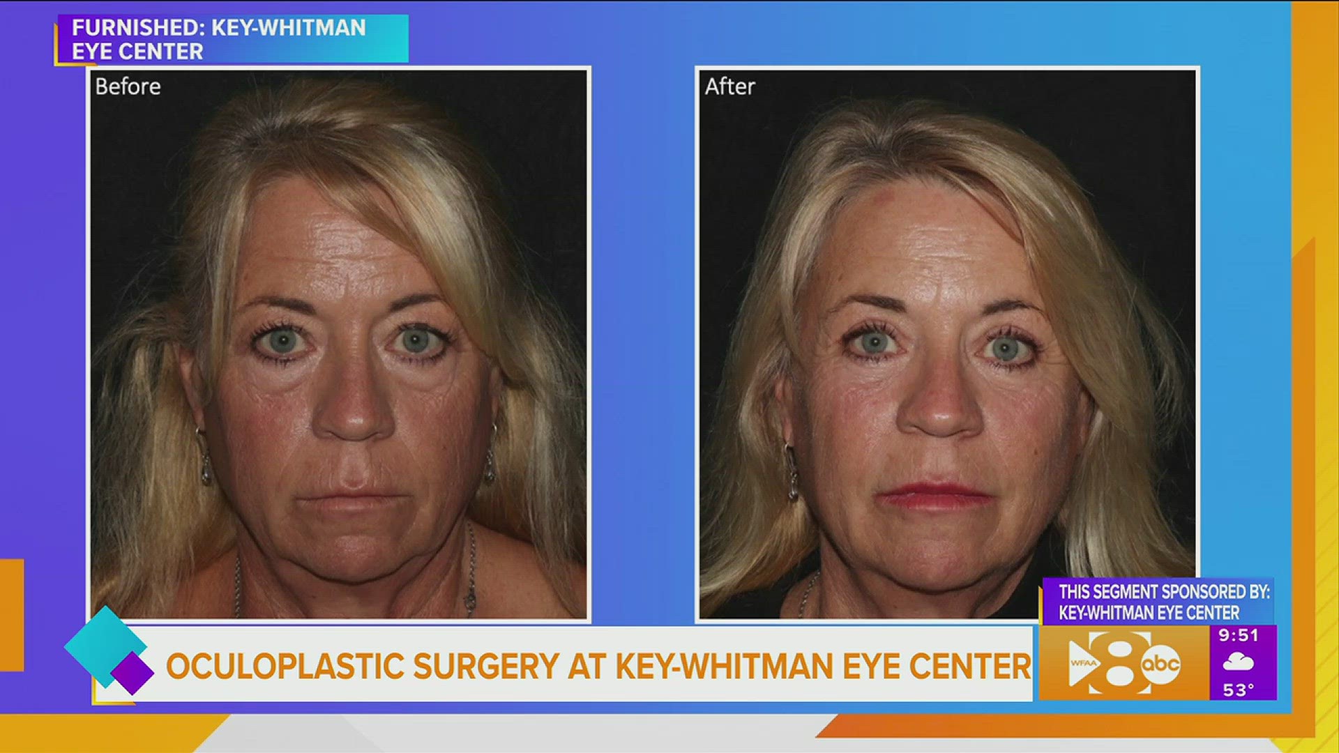 Oculoplastic Surgery at KeyWhitman Eye Center