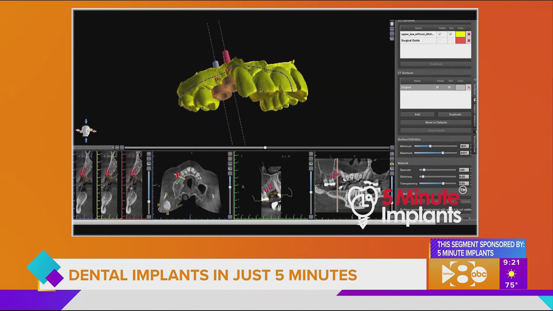 Learn how 5 Minute Implants can help you face the world with a new smile. Go to 5minuteimplants.com or call 256-IMPLANT or 214-872-278 3 for more information.