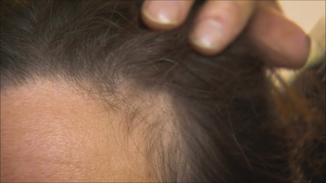 COVID longhaulers are suffering from hair loss and are desperate for a