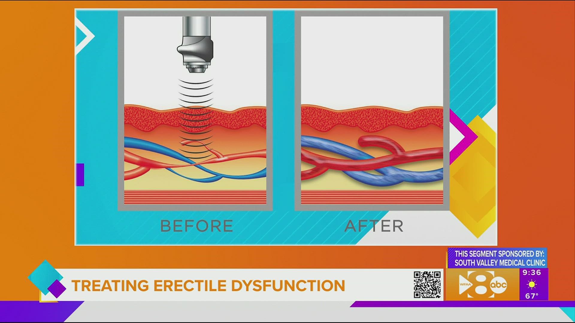 Treating erectile dysfunction