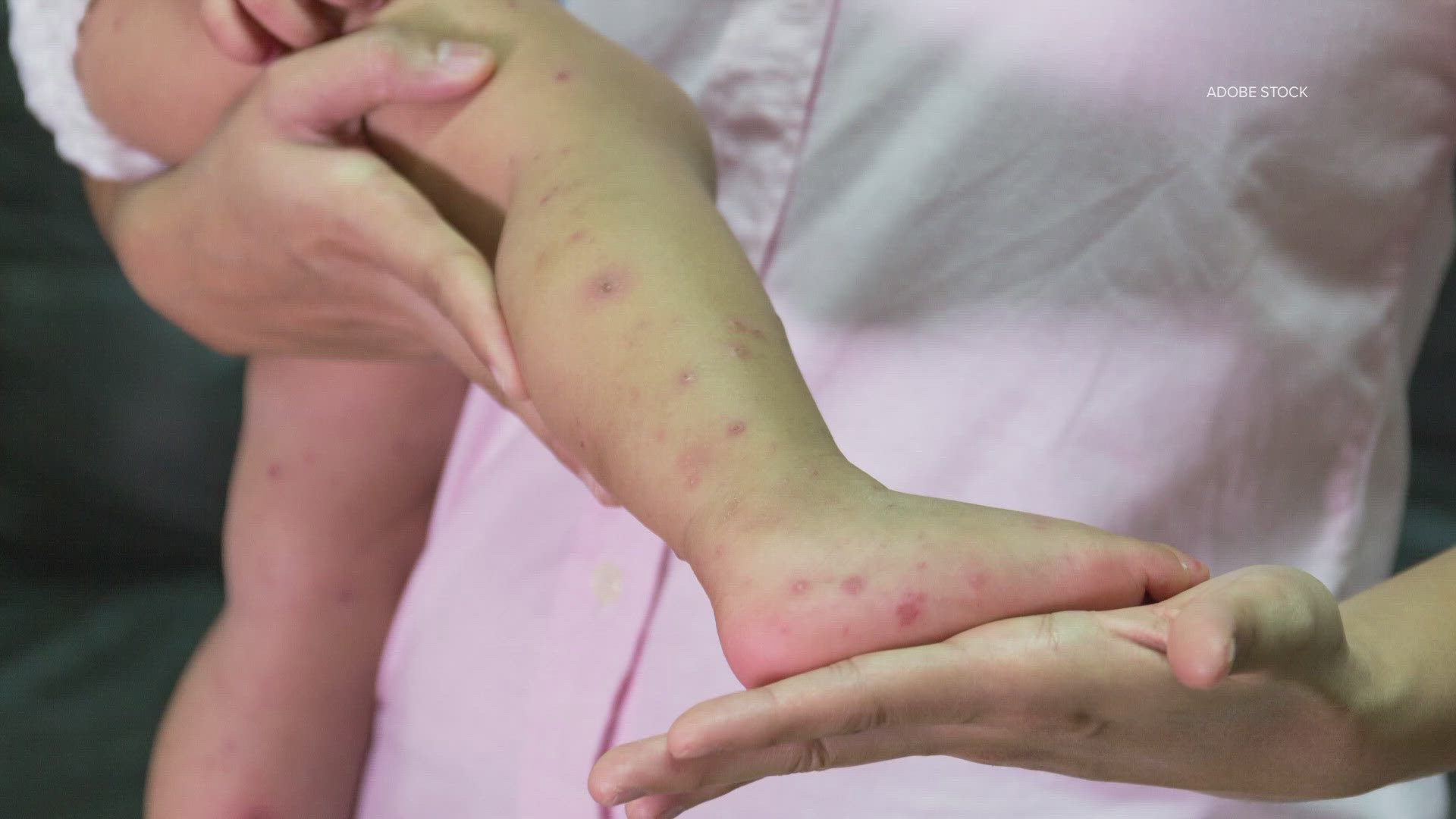 West Texas measles outbreak grows to 400 cases | wfaa.com