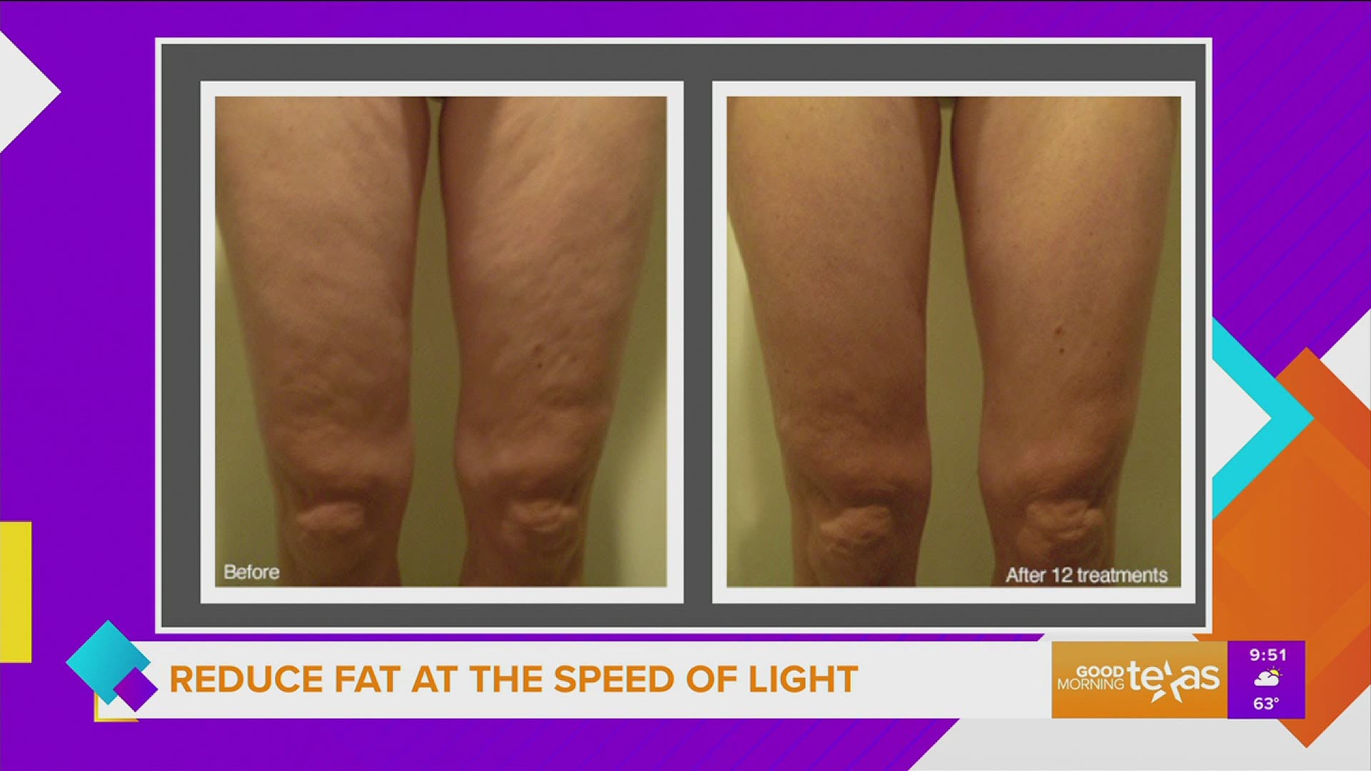 reduce cellulite with red light therapy