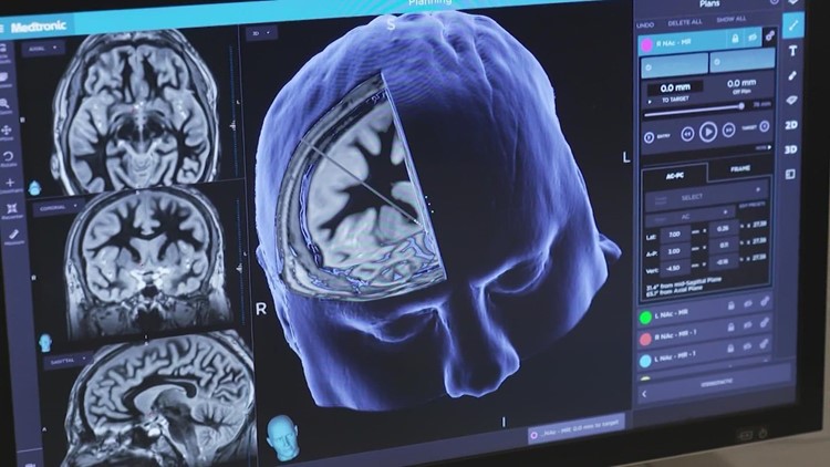 New treatment offers hope for Alzheimer's patients