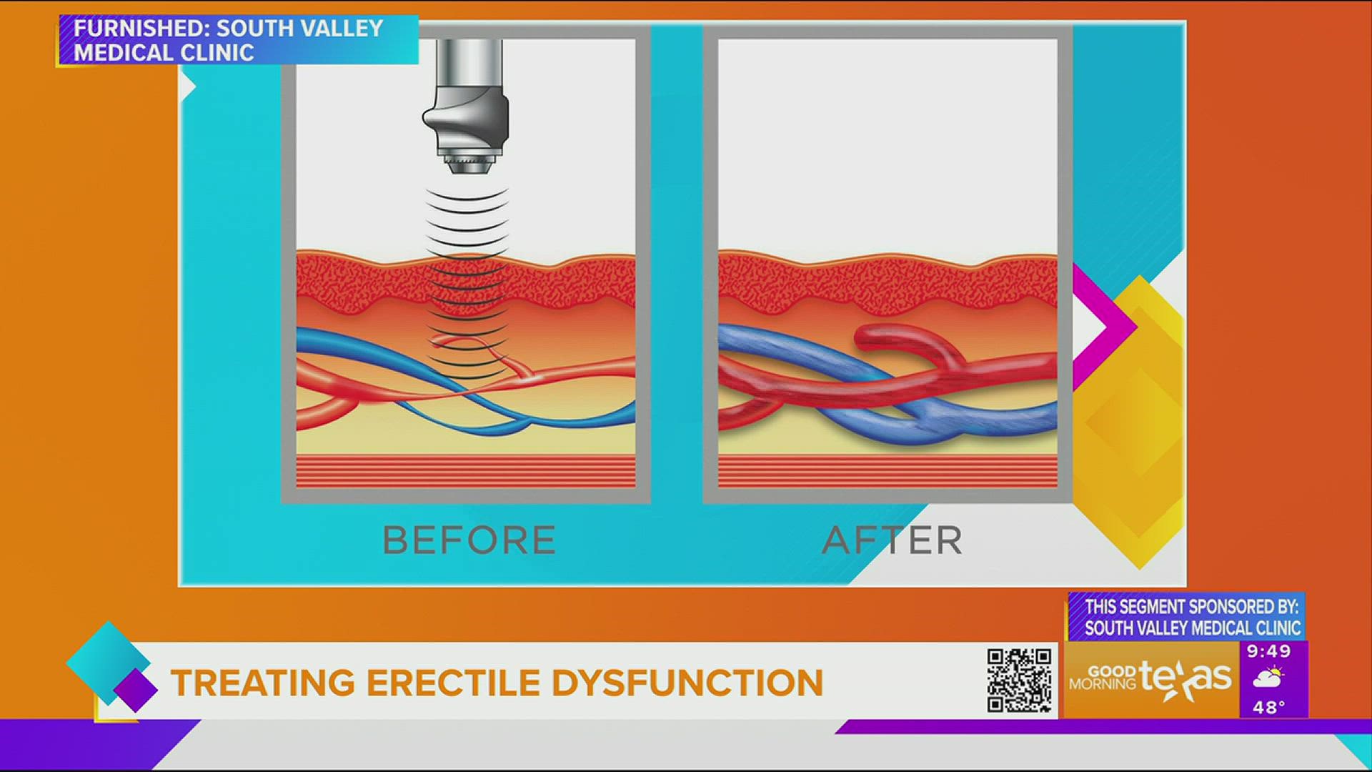 Treating erectile dysfunction