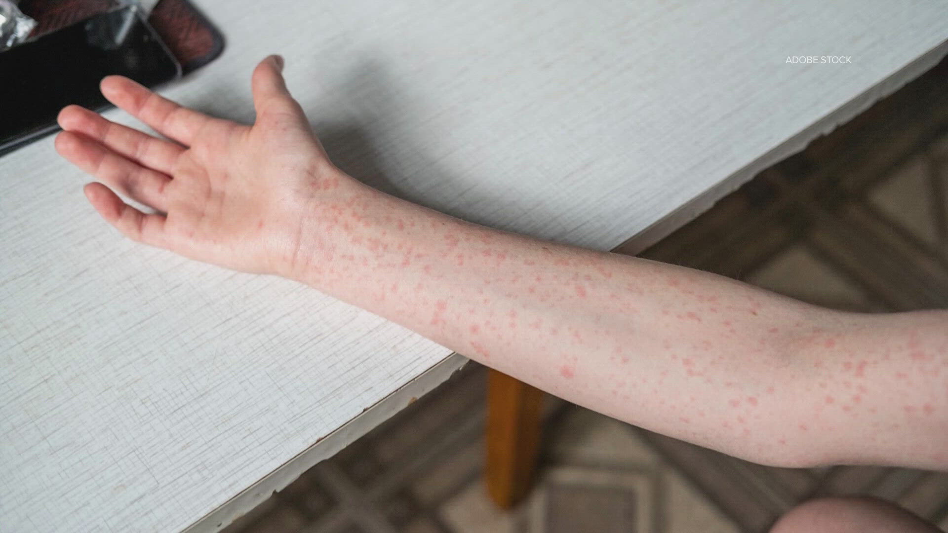 Measles cases in Texas: Plano health officials report exposure at ...