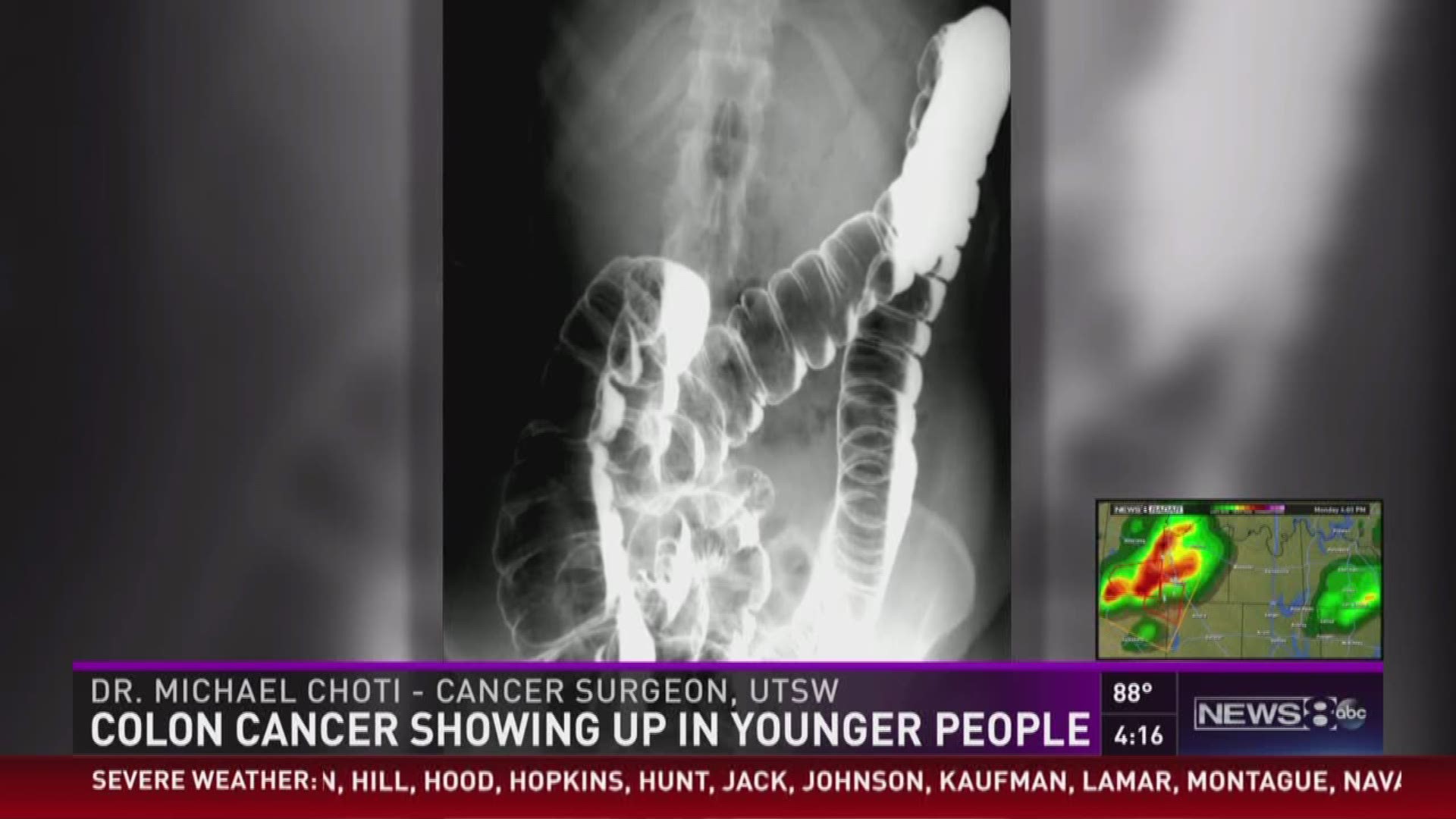 Studies are finding a greater percentage of colon cancer patients are under age 50.