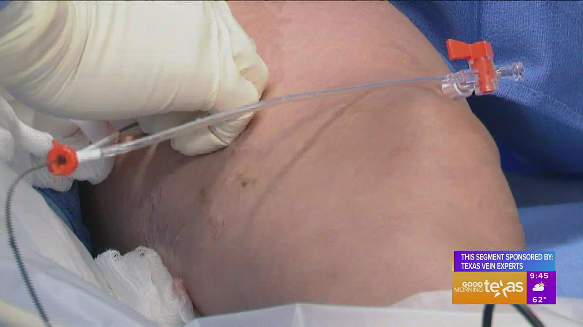 This segment is sponsored by Texas Vein Experts. Go to txveinexperts.com or call 817.904.4428 for more information.