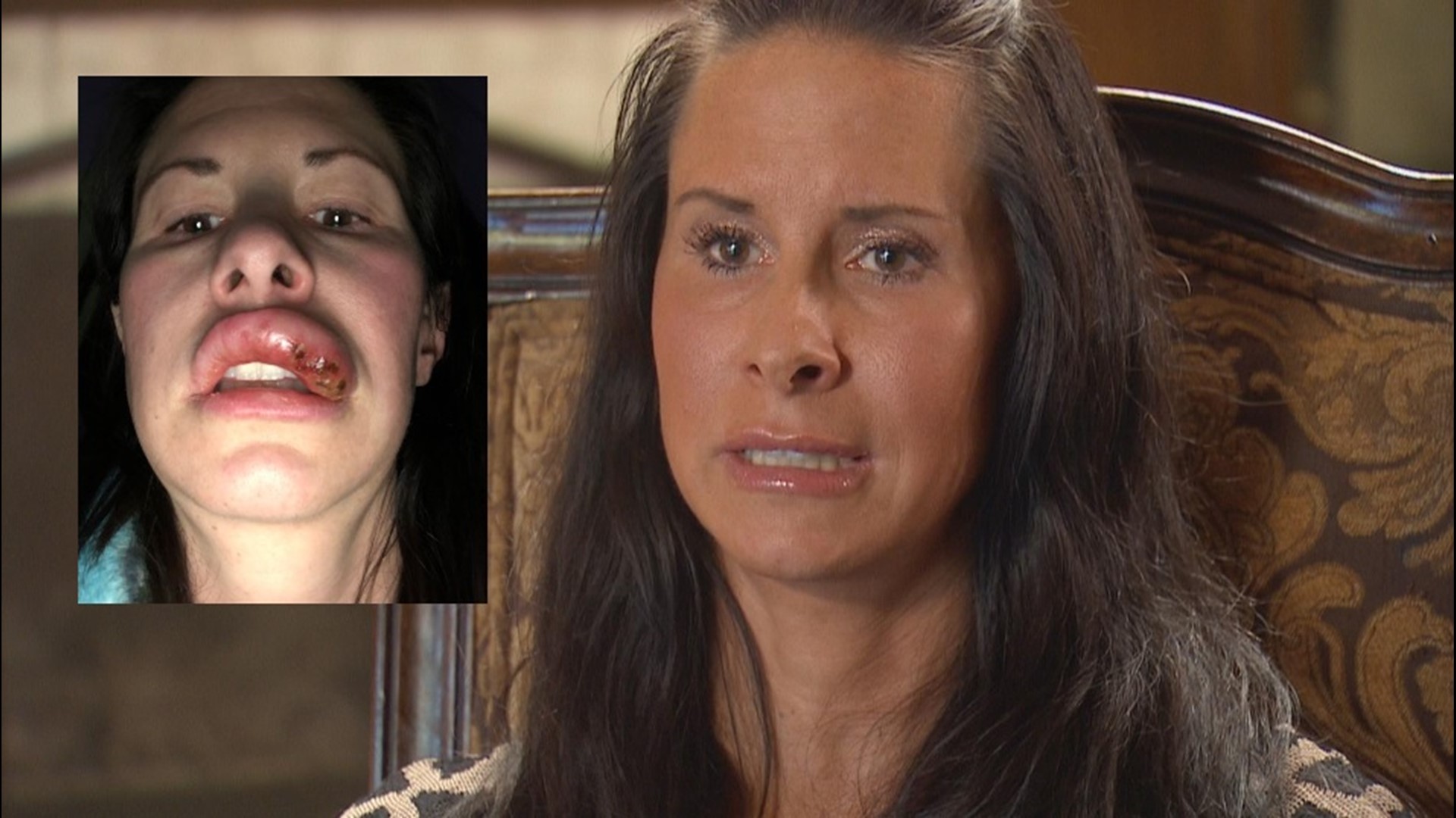 Tancy Nelson, 40, received a lip augmentation last year and learned she should have done her homework before the medical procedure.