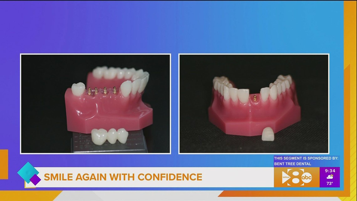 Mini dental implants