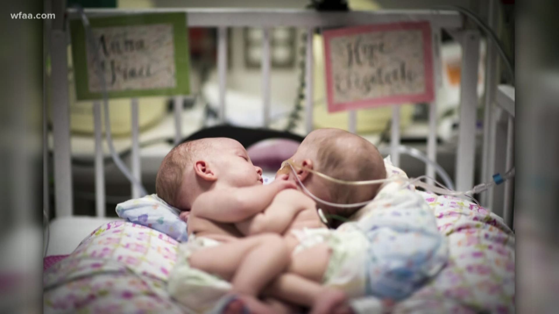 Conjoined twins from North Texas separated