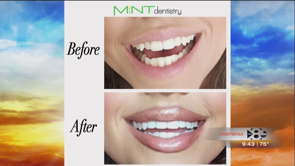 Mint Hill Before and After Teeth Whitening
