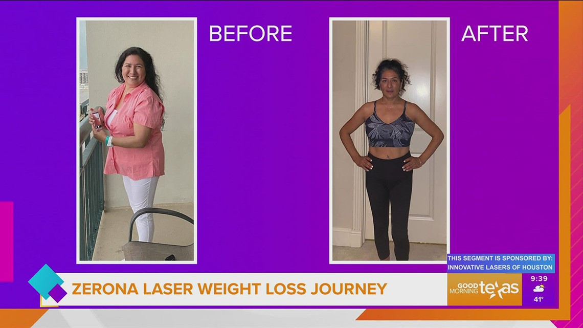 Zerona Laser Weight Loss Journey