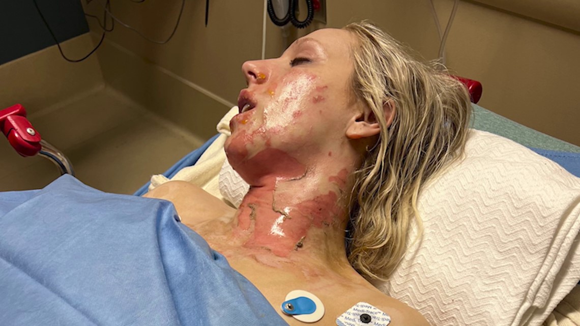 Dallas Cowboys cheerleader overcomes severe burns to make squad