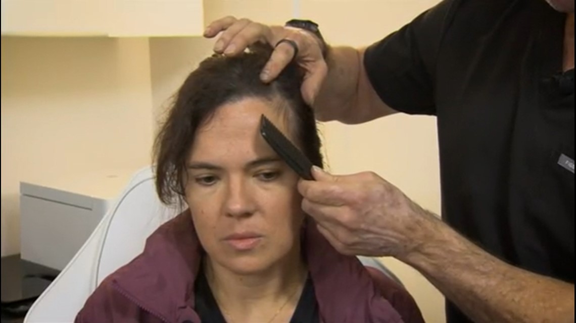 Long haulers battling hair loss due to COVID; North Texas doctors working on treatments – WFAA.com