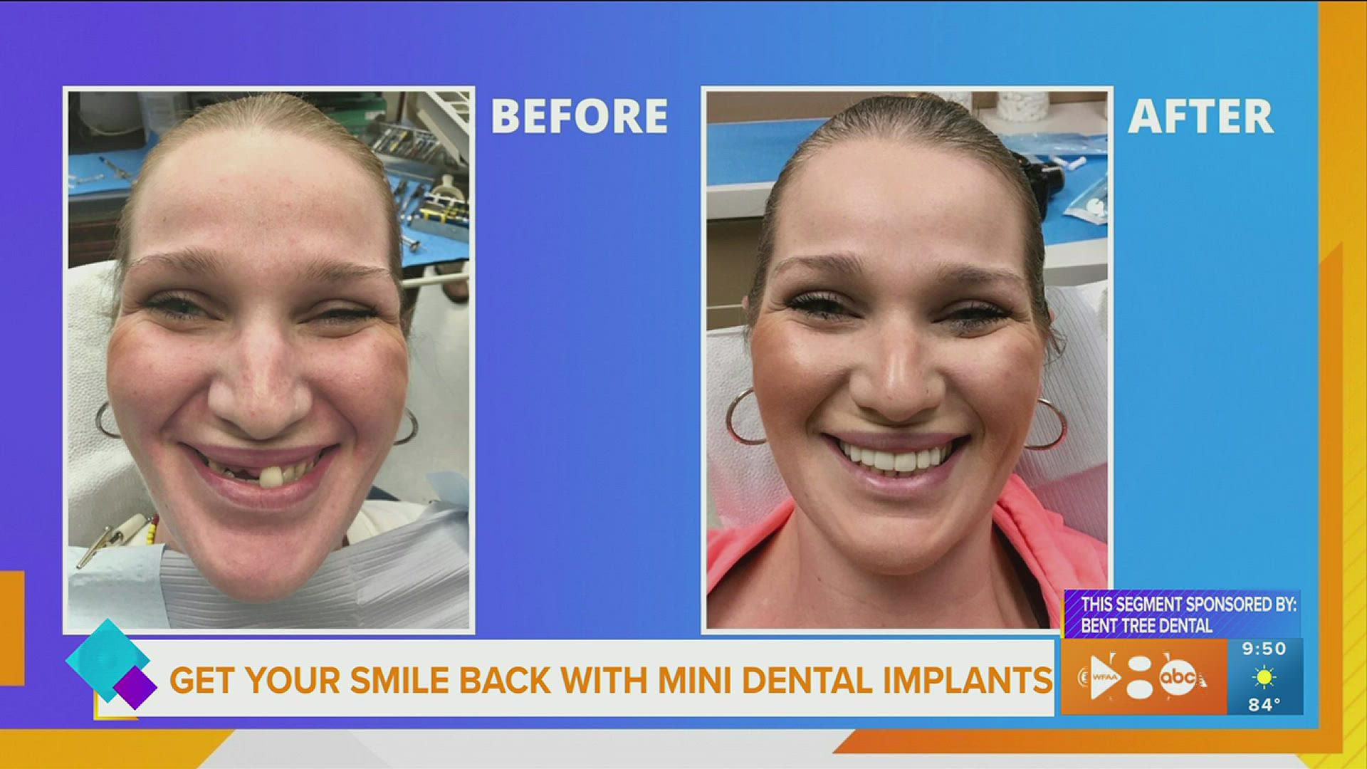 Get Your Smile Back With Mini Dental Implants 3026