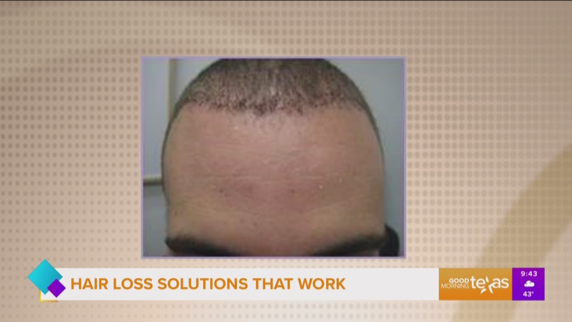 Hair Loss Solutions Dallas