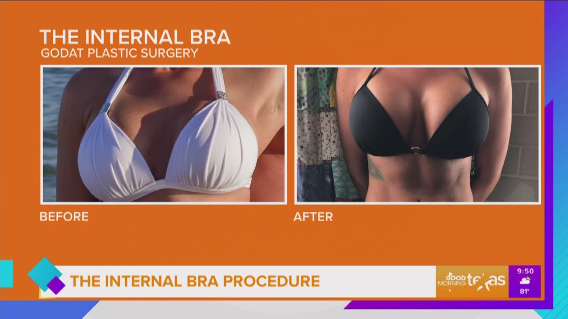 The Internal Bra Procedure