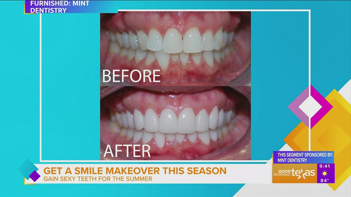 How You Can Get Sexy Teeth For The Summer Wfaa Com