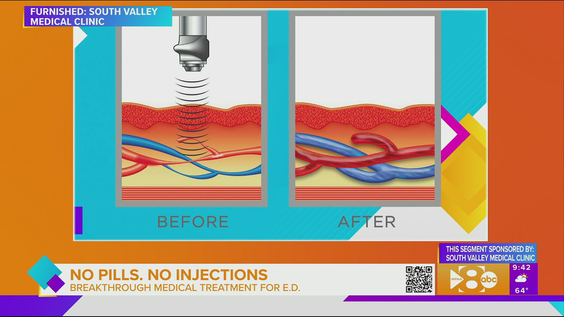 Medical treatment for erectile dysfunction No pills or injections