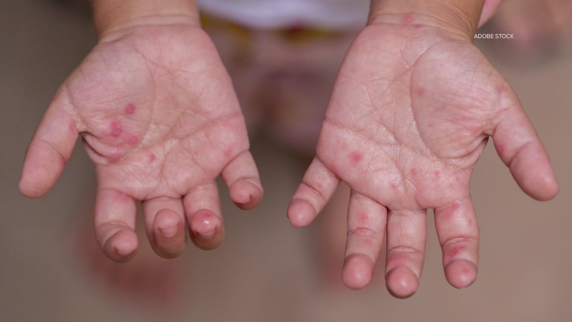 The person who contracted measles was at Methodist Mansfield ER from 8 p.m. on Tuesday, April 29 to 3 a.m. on Wednesday, April 30, health officials said.
