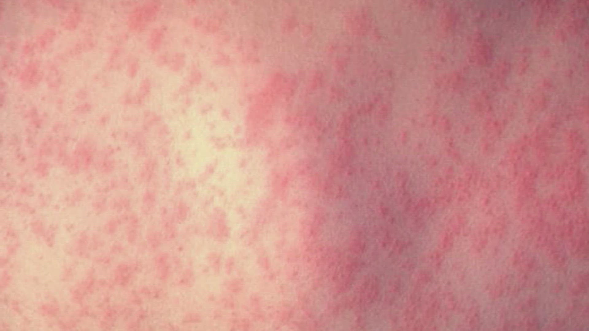 West Texas measles outbreak grows to 90 cases | wfaa.com