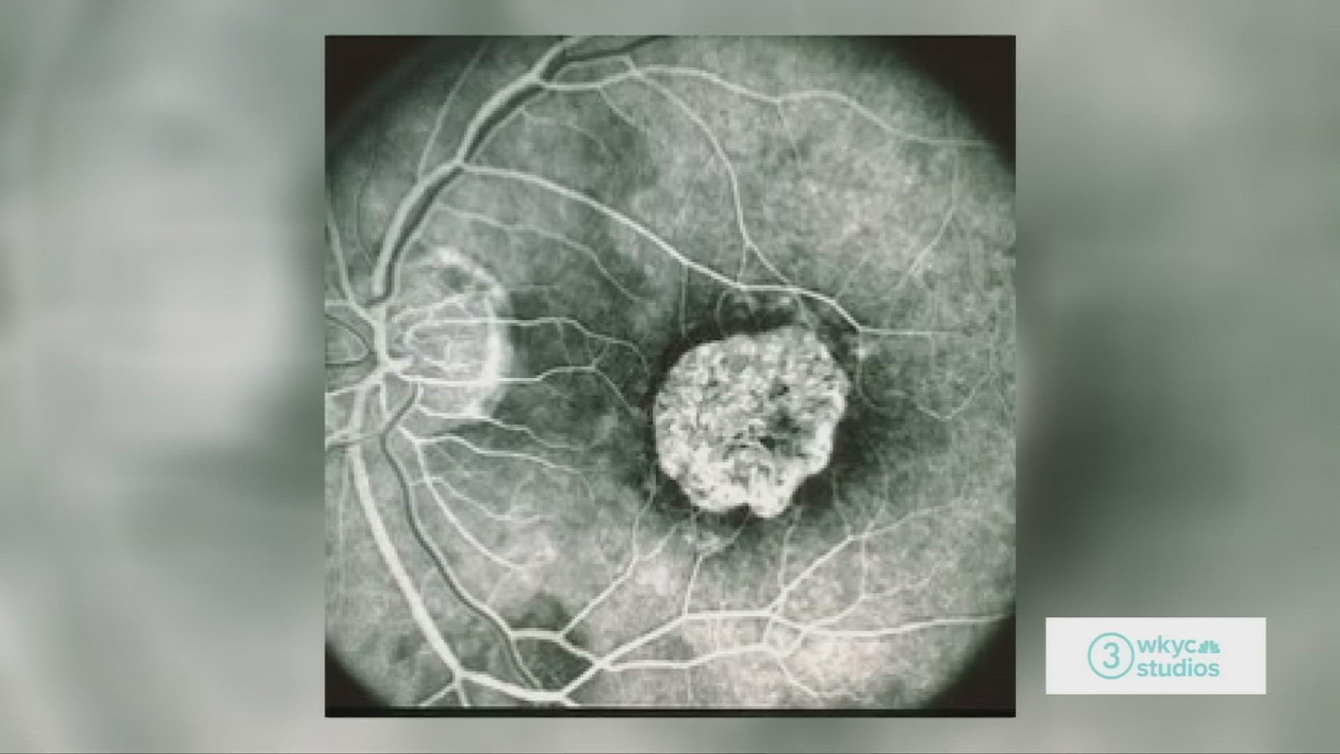 Hollie speaks with Dr. Suber Huang from the Retina Center of Ohio and Future Vision Foundation about macular degeneration, and how we can treat or prevent it.
