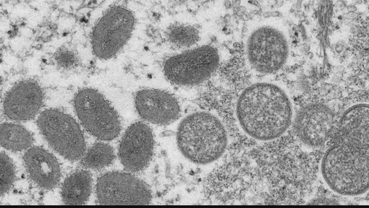 Harris County resident with various illnesses, including a presumptive positive case of monkeypox, dies, health officials confirm